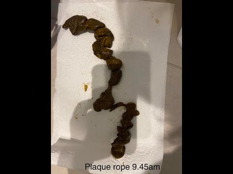 Thumbnail: Simple Bowel Cleansing Tips