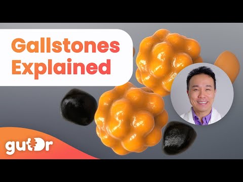 Gallstones - What Are the Causes and Symptoms? | The GutDr Explains (3D Gut Animation)