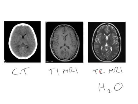 CT v MRI brain