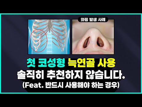 첫 코성형 재료 "늑연골" 추천하지 않습니다! ❌ (Feat. 꼭 필요한 경우!?)