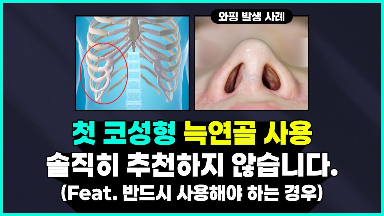 첫 코성형 재료 "늑연골" 추천하지 않습니다! ❌ (Feat. 꼭 필요한 경우!?)