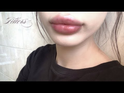 [1x MAX] 💉 2 ml of lip fillers effect (experimental)