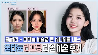 울타늄 리프팅 리얼 시술 후기
