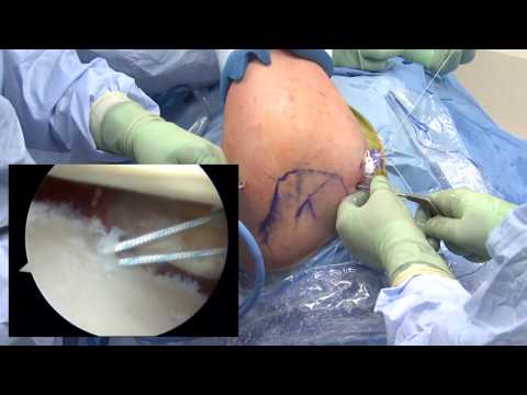 Arthroscopic Bankart Repair