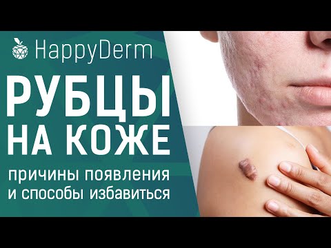 Рубцы на коже, почему появляются? Профилактика появления келоидных рубцов и как избавиться от шрамов
