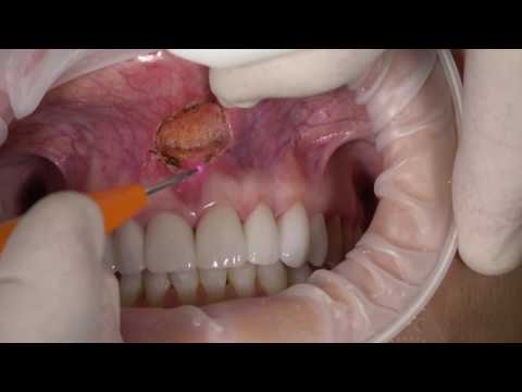 Frenektomia (wycięcie wędzidełka) z użyciem lasera stomatologicznego