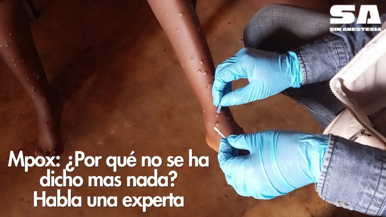 Mpox en Chicago: Revelaciones del Departamento de Salud Pública Sin Anestesia