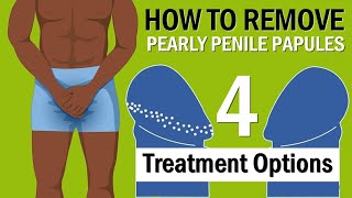 How to Remove Pearly Penile Papules - 4 Treatment Options