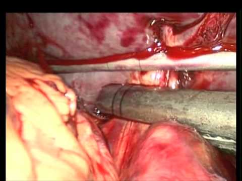 Laparoscopic Splenectomy for Symptomatic Splenic Hematoma/Collection