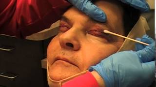 preview picture of video 'Blepharoplasty and Facelift Recovery - Carmel, IN  Dr  Mark Hamilton'