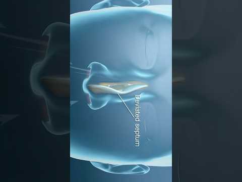 Deviated Septum Surgery (Septoplasty) for Difficulty in Breathing