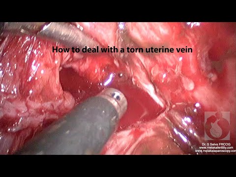 Uterine Vein Tear - And How to Deal With It