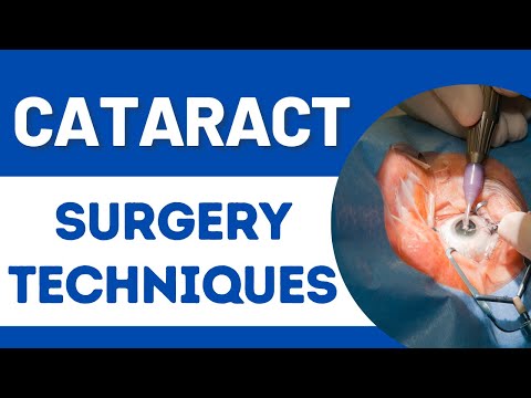 Cataract services