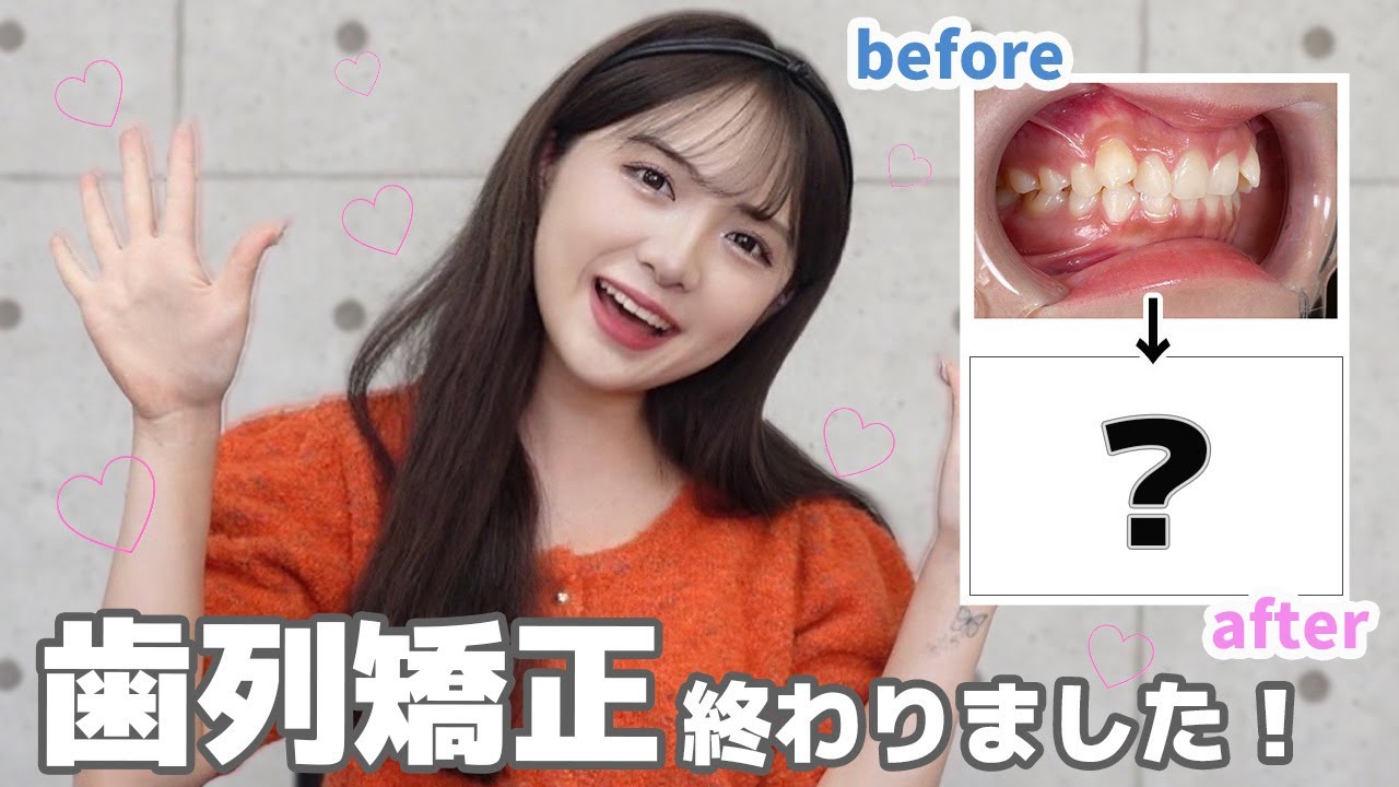 【歯列矯正】たぐ、歯列矯正終わりました🦷💖