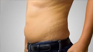 how to get rid of stretch marks on stomach after weight loss