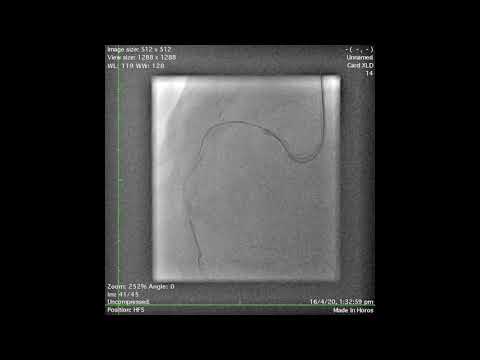 Complex PCI of Calcified RCA CTO