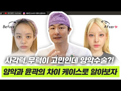 안면윤곽 실제 케이스로 알아보는 사각턱,무턱 수술 효과 ㅣ디에이성형외과