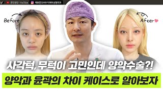 안면윤곽 실제 케이스로 알아보는 사각턱,무턱 수술 효과 ㅣ디에이성형외과