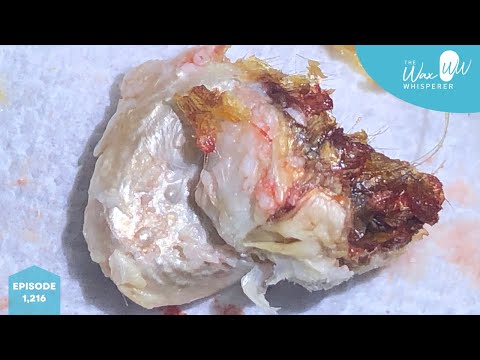 1,216 - Severe Grade III Keratosis Obturans Removal using Ear Hook