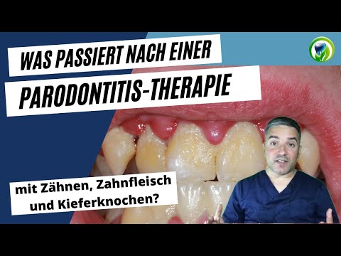 Was passiert mit Zähnen, Zahnfleisch und Kieferknochen bei einer Parodontitistherapie?
