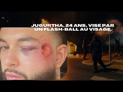 Jugurtha, 24 ans, visé par un tir de flash-ball au visage pendant les révoltes à Rueil-Malmaison.