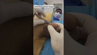 Download lagu Penile Lipofilling before surgery and Stem Cell therapy in Andrology Penilenlargement.com #penis mp3 Download lagu Penile Lipofilling before surgery and Stem Cell therapy in Andrology Penilenlargement.com #penis mp3