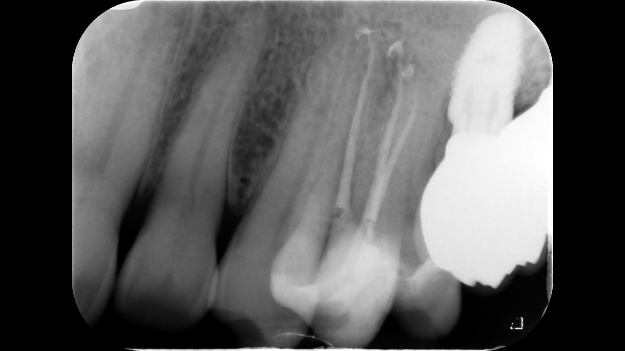 maxillary premolar enigma   4K