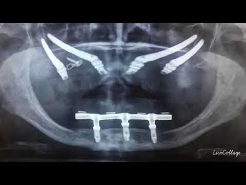 Implantes cigomaticos caso