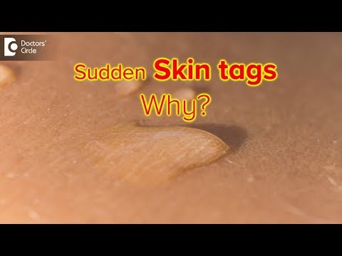 Why do I suddenly have skin tags? Are they dangerous? - Dr. Rasya Dixit