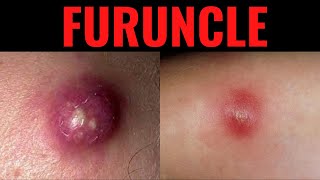 What is Furuncle? Furuncle (Boil) Definition,Causes, Symptoms, Risk Factors, USMLE
