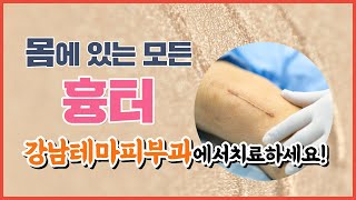 치료 효과 의심? 없애드리겠습니다!ㅣ여드름 흉터, 없애는법, 시술, 치료, 효과