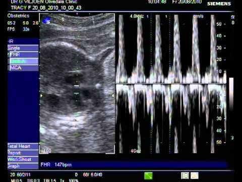 Bump Scan 20 August 2010