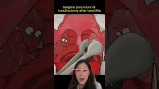 Tonsillectomy Procedure Cartoon (fast &amp; easy) #shorts #tonsils