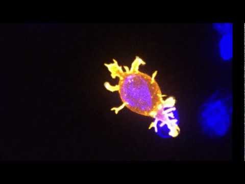 Limfocyt NKT (Natural Killer T-cell)  atakujący komórkę rakową
