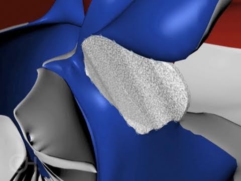 Treatment Options for Tetralogy of Fallot (TOF) - The Children's Hospital of Philadelphia