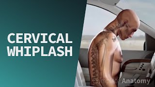 Cervical Whiplash | Trauma