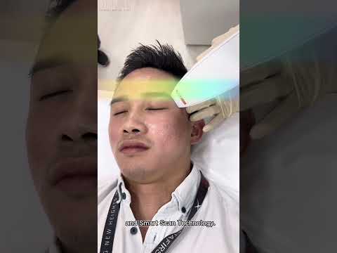 Venus Viva Scars Resurfacing | 维斯点阵射频 | RF 换肤仪器 | Define Aesthetic Medical Clinic