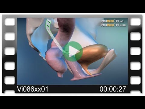 DynaMesh®-PR - Animation: Colposacropexy