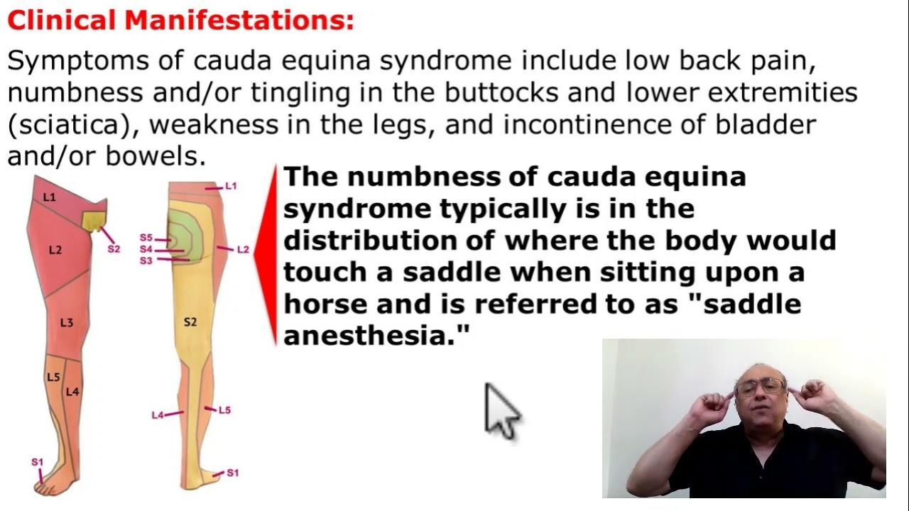 Cauda Equina Syndrome (Cauda Equina Lesion)