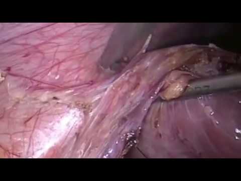 Trick to expose pelvis in posteriorly malrotated kidney by Dr Rasik Shah