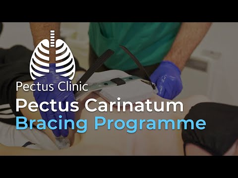Pectus Clinic - Bracing for Pectus Carinatum (Pigeon Chest) Deformity