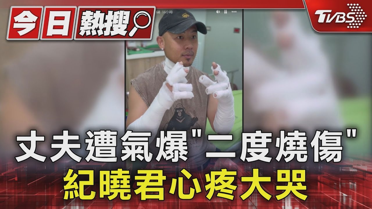 丈夫孫庭浩開店遭氣爆「二度燒傷」 紀曉君心疼大哭:你痛我也痛