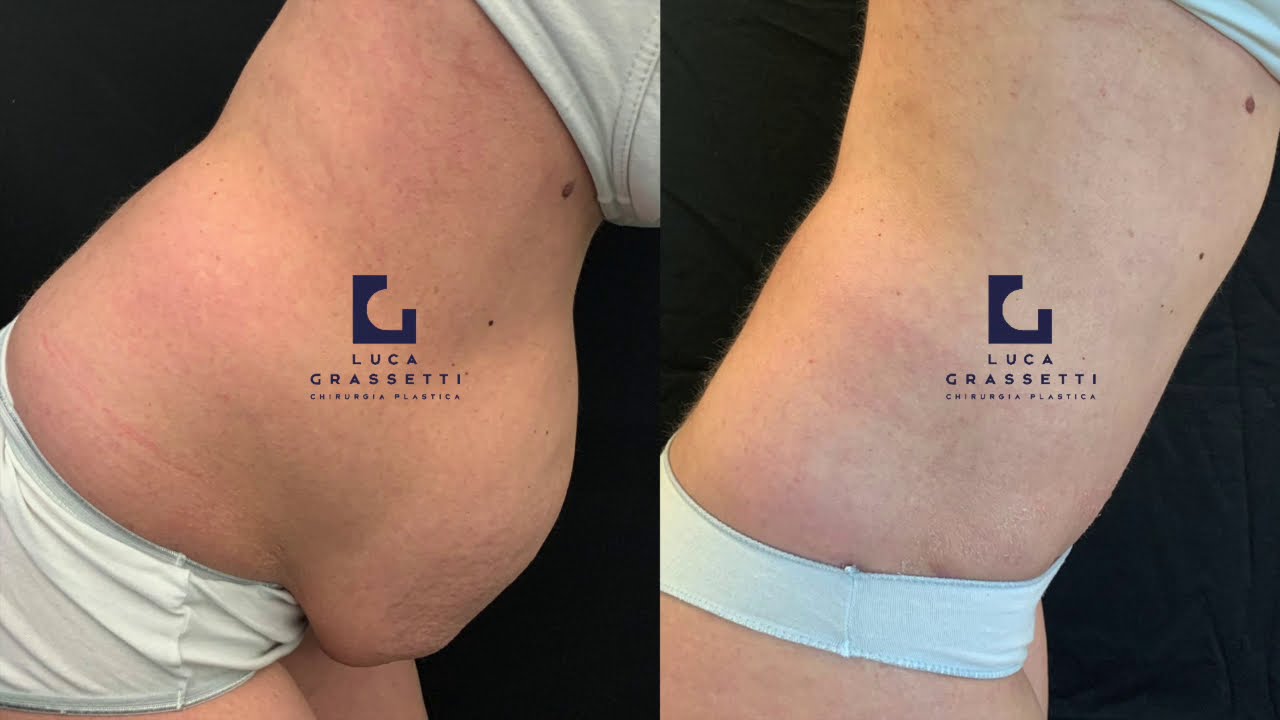 Bozza dopo Diastasi Addominale