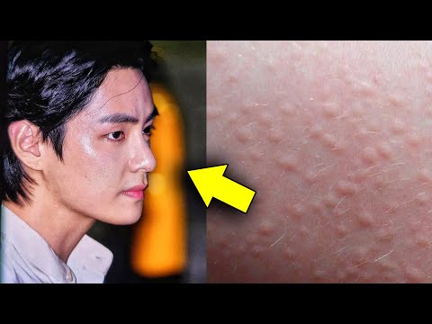 V's skin condition, Tae's first tattoo finally revealed