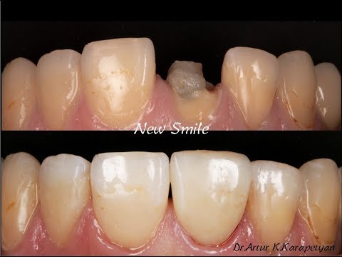 Восстановление зуба 1.1 после травматического перелома его коронковой части
