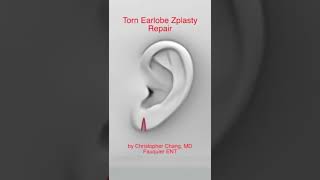 Torn Earlobe Z plasty Repair