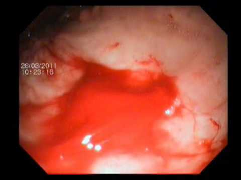 Bleeding Gastric Ulcer