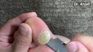 Calluses on Toes At Home  How To Removal Giant