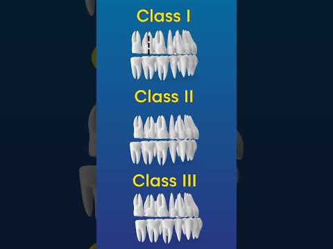 Angle's Classification of Malocclusion