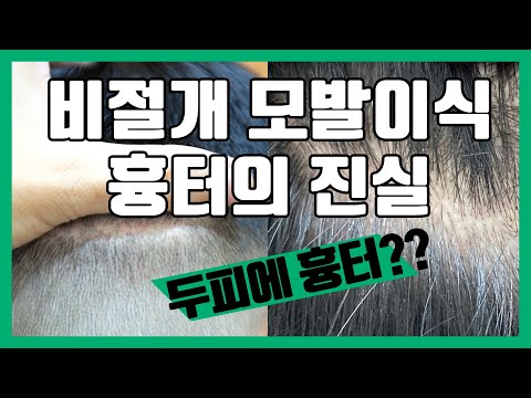 비절개 모발이식은 흉터 없다는데..?